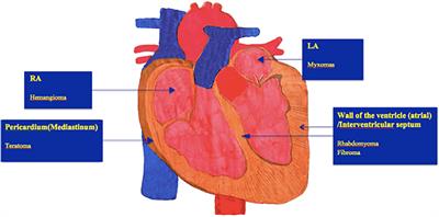 Current status of diagnosis and treatment of primary benign cardiac tumors in children